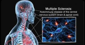 Le cause neurologiche della sclerosi multipla