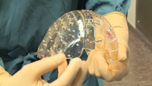 La protesi di calotta cranica stampata in 3D utilizzata per l'intervento realizzato in Olanda
