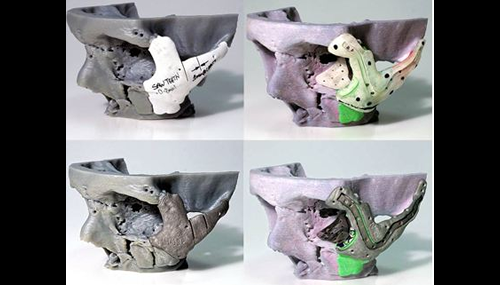 Progettazione e stampa di protesi ossee per la ricostruzione facciale grazie alle tecnologie 3D