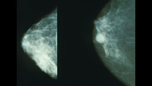 Screening mammografico: nella foto l'immagine mammografica di un seno sano a destra e di un seno connodulo tumorale ("Mammo breast cancer". Con licenza Public domain tramite Wikimedia Commons - http://commons.wikimedia.org/wiki/File:Mammo_breast_cancer.jpg#mediaviewer/File:Mammo_breast_cancer.jpg)