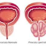 cancro-alla-prostata