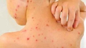E' bene tagliare le unghie ai bambini ammalati di varicella, per evitare che essi grattandosi si procurino ferite