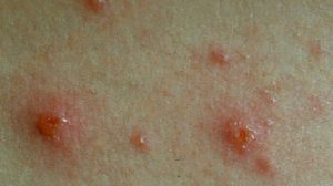 Le macchie rosse caratteristiche della varicella